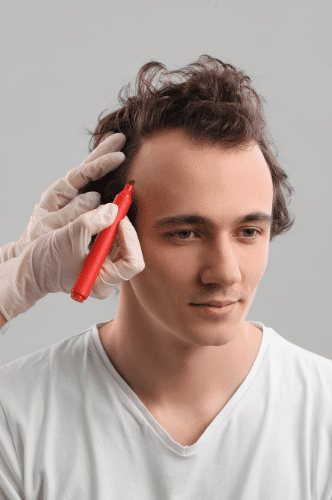 Dr. Bruce Marko FUE Hair Restoration Procedure