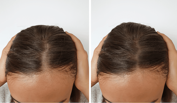 Female Hair Loss Treatment - Dr. Bruce Marko